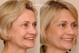 Deep Overbite Correction Plastic Surgery Overbite Correction Facial