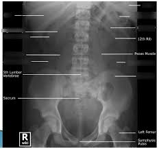 Image result for Abdominal XRay