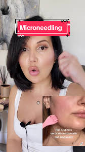 Can I Use Qure Microneedling Once Per Week