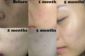 Reviews help our community members find before i bought this serum, i had extremely bad acne and very textured skin. The Ordinary Niacinamide Review Before And After
