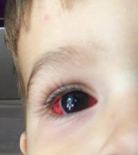 Blutung Im Auge Forum Kleinkind Urbia De