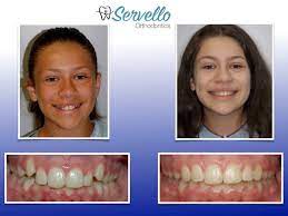 Welcome to servello orthodontics, the office of david servello, d.m.d., a premier orthodontic care provider dedicated to creating beautiful, confident smiles in central pennsylvania. Servello Orthodontics Photos Facebook