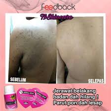 Dan kalau yang teruk sampai bernanah. Tips Hilangkan Jerawat T9 Skincare