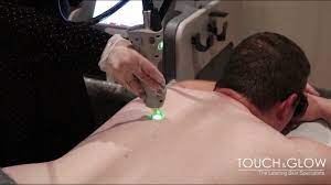 There are different waiting times depending on what hair removal cream you've used. Candela Male Laser Hair Removal Youtube