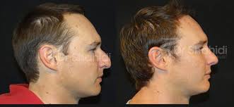 Check spelling or type a new query. Male Rhinoplasty Before And After Gallery