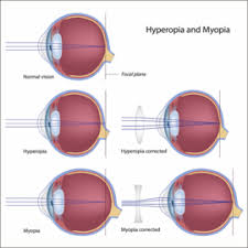 myopia and hypermetropia optical masters of denver