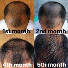 Procedure Fue Hair Transplant Surgery Before And After Photos Of Our Dear Patient From The 1s Fue Hair Transplant Hair Transplant Hair Transplant Surgery