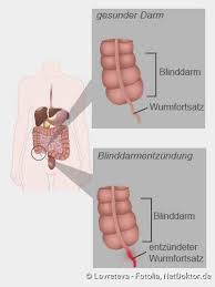 Welche funktion hat der blinddarm? Blinddarmentzundung Symptome Behandlung Ursachen Netdoktor