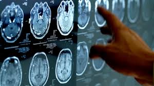 Postmenopausal bleeding is vaginal bleeding that occurs after menopause; Bleeding After Menopause It S Not Normal Cancer Ut Southwestern Medical Center