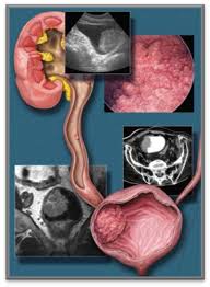 The good news is the chance for the cancer turning malignant or turning into a melanoma are. Ureteral Cancer And Ureteral Urothelial Carcinoma Saint John S Cancer Institute Santa Monica Ca
