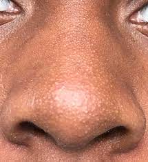 Check spelling or type a new query. Skin Concerns How To Get Rid Of Textured Nose Small White Heads On Nose Skincareaddiction