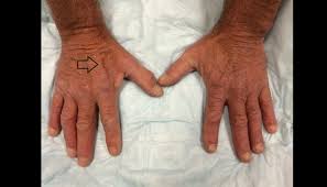 Aug 10, 2020 · lipodystrophy is a disorder that affects how a person's body accumulates and stores fat. Ortho Dx Atrophy To The First Dorsal Web Space Of The Hand Clinical Advisor