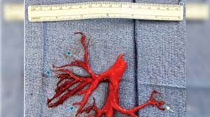 When an injury occurs, the body emits clotting agents to keep blood spillage to a minimum. Man Admitted To Ucsf Hospital Coughs Up Blood Clot In Shape Of Lung