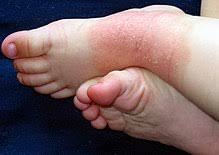 Tritt neurodermitis beim baby oder beim kleinkind auf, machen sich viele eltern große sorgen, diese sind jedoch meistens unbegründet. Atopisches Ekzem Wikipedia