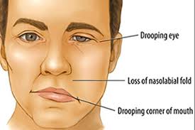 Once they happen, they get worse over the next 48 to 72 hours. Bell S Palsy Facial Paralysis Symptoms Ayurvedic Treatment