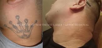 Maybe you would like to learn more about one of these? Benchmark Tattoo Fade Away Laser Tattoo Removal Duluth Mn Cylex