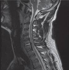 Healthy Cervical Spine Mri