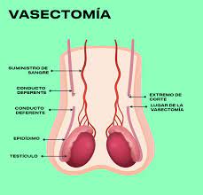 La vasectomía o deferentectomía consiste en la sección y ligadura de los conductos deferentes. La Vasectomia Es El Metodo Anticonceptivo Mas Efectivo Disponible Y Se Puede Revertir