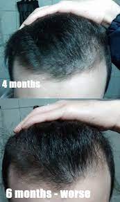 Use a hydrating serum such as hyaluronic acid before microneedling to lubricate the skin, helping. Haarausfall Allgemeines Forum Haare Und Haarausfall Shedding Nach 5 Monaten Big 3