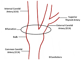 Image result for carotid artery