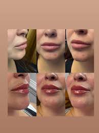 Carrie Ramos BSN RN Aesthetic Injector (@goddess_injector) • Instagram  photos and videos