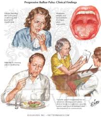 Image result for Progressive Bulbar Paralysis