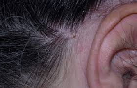 With scalp psoriasis, the affected patches of skin are scaly and dry and do not usually form a ring. Scalp Psoriasis Shampoos Scale Softeners And Other Treatments
