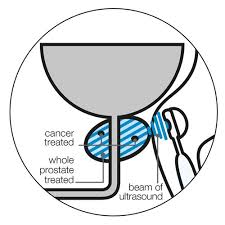 Getting a diagnosis of bladder cancer can be a difficult time. High Intensity Focused Ultrasound Hifu Prostate Cancer Uk