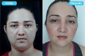 Bichectomy ➞ improves the contour of the face! Facial Wasting Bichectomia