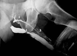 Image result for Retrograde Urethrogram