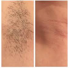 View how laser hair removal works and more info about the best treatment options for light and dark skin tones. Laser Hair Removal In West London The Hogarth Medispa