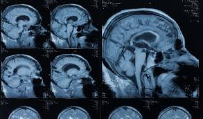 For navigation in the gap segment, consider tools such as google maps. Kopf Mrt Zur Entdeckung Von Hirnthrombosen Conradia Radiologie Hamburg