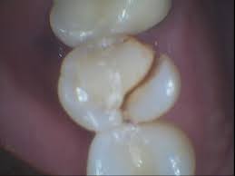 Are you put to sleep for a root canal. Why You Need A Dental Crown After Root Canal Treatment Dr Joffe