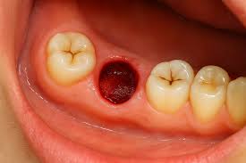 Image result for Alveolitis sicca)