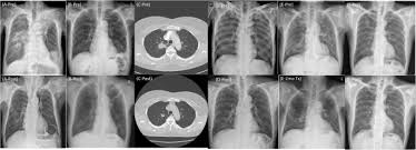Lung cancers are generally divided into 2 main categories: Pulmonary Tuberculosis Presenting Secondary Organizing Pneumonia With Organized Polypoid Granulation Tissue Case Series And Review Of The Literature Bmc Pulmonary Medicine Full Text