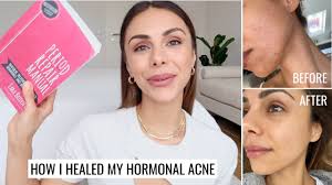 When women come to see me they can be in tears because their skin has impacted them so severely. How I Healed My Hormonal Acne Diet Supplements Skincare Annie Jaffrey Youtube