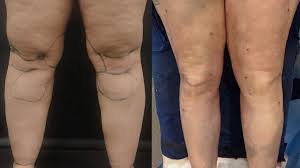 The bones of the upper and lower leg, the. Knee Liposuction Procedure Recovery Side Effects Cost