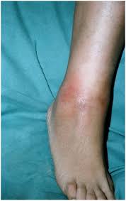 Image result for erythema nodosum