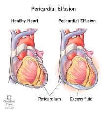 Image result for Pericardium