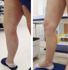 Vosstanovlenie Posle Lazernoj Koagulyacii Ven Plyusy I Minusy Lazernogo Udaleniya Ven