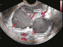 Endometriosis is common in women during the years they can have children. Scielo Brasil Transvaginal Ultrasound In Deep Endometriosis Pictorial Essay Transvaginal Ultrasound In Deep Endometriosis Pictorial Essay