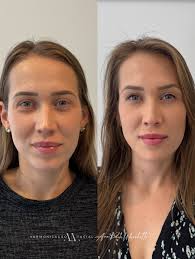 São os pequenos detalhes que transformam, sem que ninguém saiba o que  mudou, mas todos percebam que algo está diferente. ✨ Harmonização é sobre  isso: realçar o que já é belo, sem