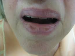 Geriatric patients generally have comorbid complications along with xerosis. Xerosis Dry Skin Dermatology Advisor