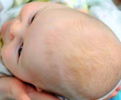 Image result for Cradle Cap