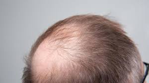 Haarausfall ist ein weit verbreitetes problem. Haarausfall Stoppen Was Bringen Shampoos Oder Medikamente