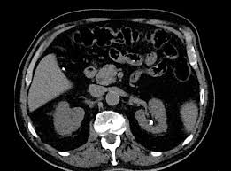 Maestro Portal Procedure Flexible Ureteroscopy And Laser Dusting Of 8 Mm Kidney Stone Key points about kidney stones. laser dusting of 8 mm kidney stone