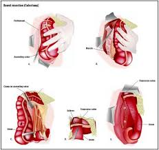 Recovery of water and electrolytes. Bowel Resection Procedure Recovery Blood Tube Removal Pain Complications Time