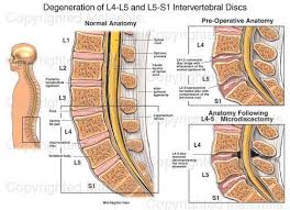 Pin By Pb On Spinal Stenosis Arthritis Intervertebral Disc Degenerative Disc Degenerative Disc Disease