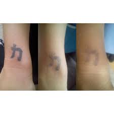 Explain the procedure for tattoo removal, aftercare and costs; Invisible Ink Laser Tattoo Removal Mobile Bristol Tattoo Removal Yell