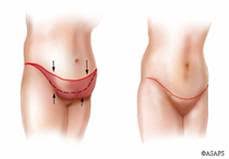 Be sure to consult with your insurance company in advance of any surgery. Panniculectomy After Weight Loss California Surgical Institute